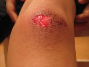 Lukanya sampai ke hati Mommy.