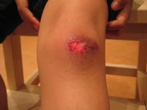 Luka di lutut nampak berdarah...